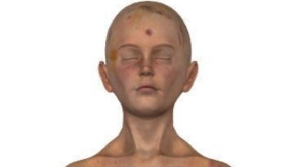Daniel Pelka's head was covered in bruises.