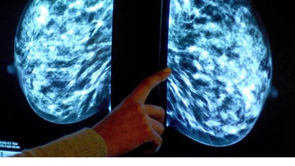 Mammogram