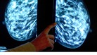 Mammogram