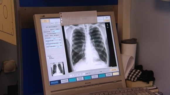 Chest x-ray