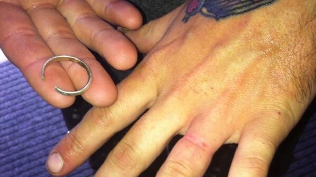 Stuck wedding ring