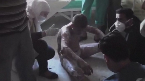 A boy with severe burns sits on the floor of the make-shift medical centre to be treated.