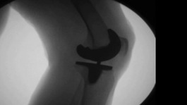 X-ray showing an arthritic joint