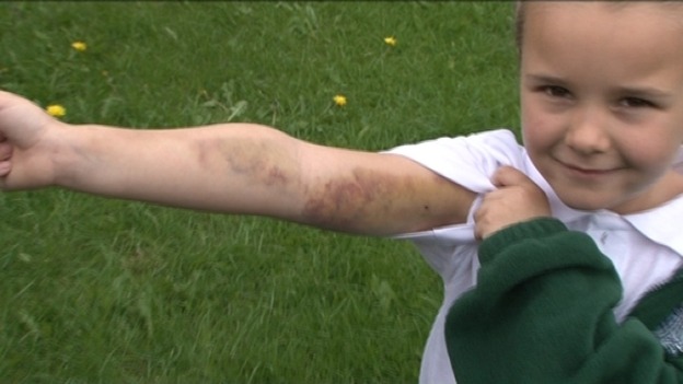 Bruised arm of Peyton Jackson, 5, who escaped fire by jumping out of window onto trampoline with family
