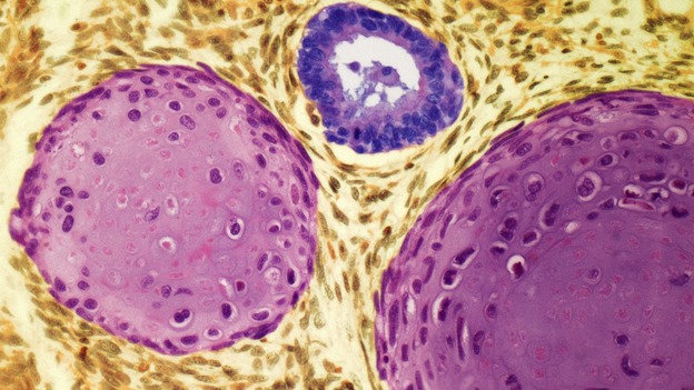 A testicular cancer tumour, seen under a microscope inside a testis. The tumour is between 10 and 30 years of age.