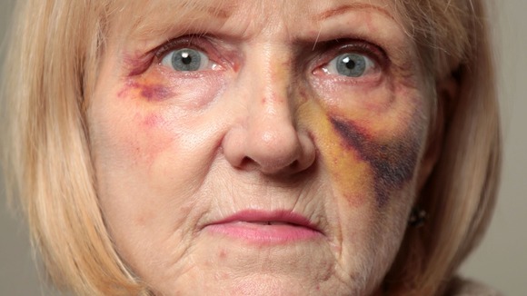Beaten Nurse