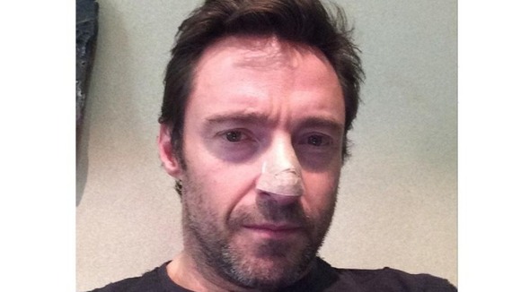 Hugh Jackman posted a picture of his nose after being treated for skin cancer.