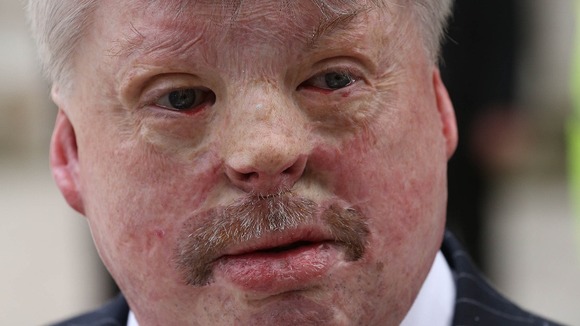 Falklands war veteran Simon Weston has called for a more realistic portrayal of injured service personnel.