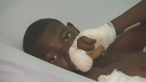 A 13-year-old boy who had his fingers deliberately cut off.