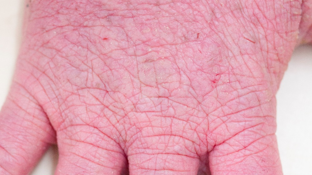 Could silk clothing help people with eczema? Central ITV News