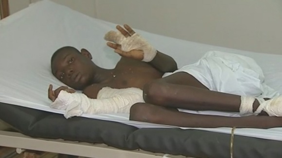 A 13-year-old boy who had his fingers deliberately cut off.