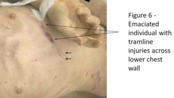 Photo purporting to show injuries on a dead prisoner (comments are from the Cart-Ruck report)