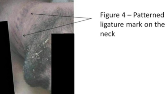 Photo purporting to show injuries on a dead prisoner (comments are from the Cart-Ruck report)