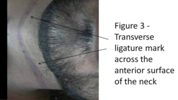 Photo purporting to show injuries on a dead prisoner (comments are from the Cart-Ruck report)