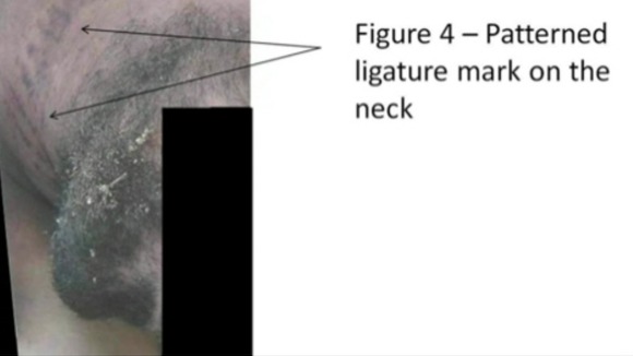 Photo from the report purporting to show injury on a prisoner's neck (comments by report authors)