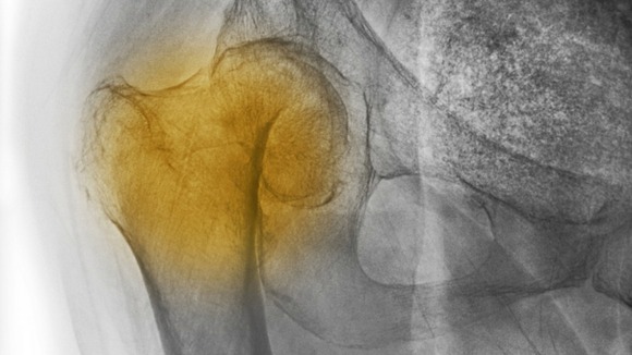 x-ray showing a hip fracture in a patient with osteoporosis