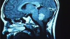 Brain tumours are the biggest cancer killer of children in the country.