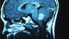 Brain tumours are the biggest cancer killer of children in the country.