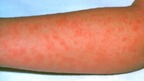 Scarlet fever causes a distinctive pink-red rash