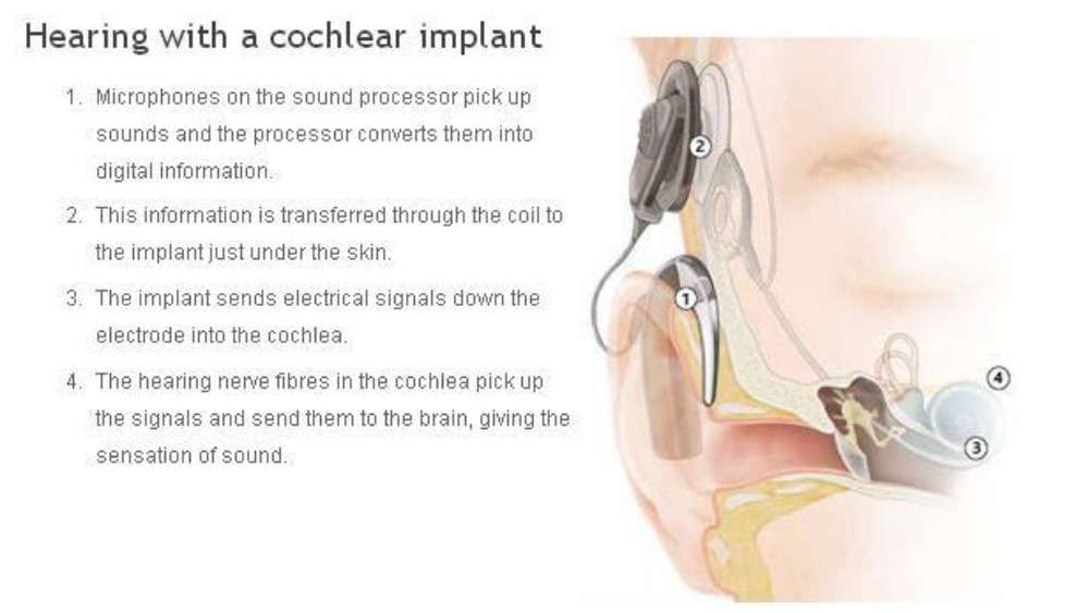 The small device that helped a deaf woman hear for the ... hearing diagram 