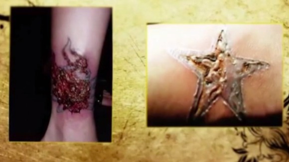 Unsterilised equipment can lead to infection.
