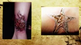 Unsterilised equipment can lead to infection.
