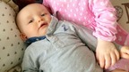 Baby Jacob and his sister will undergo surgery at the end of this month