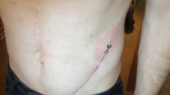 Stephen had a pair of scissors tattooed along one of his surgical scars
