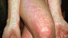 Increase in cases of Scarlet Fever in the South