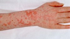 Cases of Scarlet Fever soar across the South West