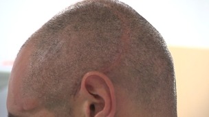 Lee's skull after the operation.
