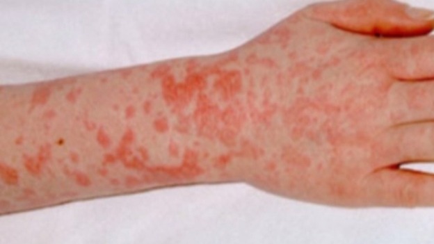 The rash feels like sandpaper to touch and can be itchy.