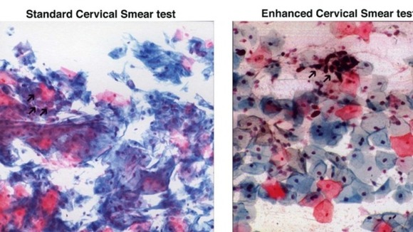 The Government say smear tests on younger women are far more likely to come back with abnormal results that are not cancerous.