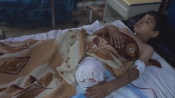 Saleh had to have his left leg amputated.