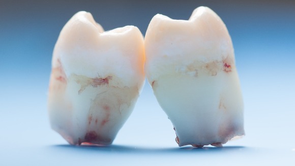 The technique developed at King's College London does away with fillings and instead encourages teeth to repair themselves.