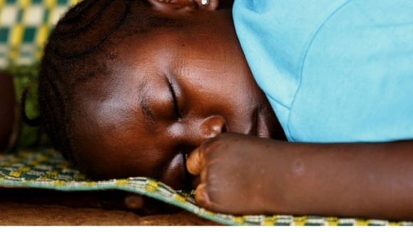 A Sierra Leonean girl who had her hand amputated by RUF rebels in January 1999 .