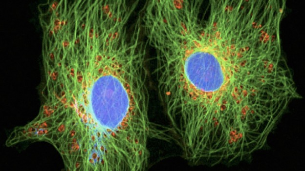Cancer cells under a microscope