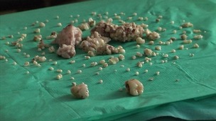 The teeth are seen following surgery.