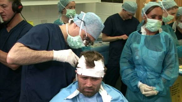 Michael Gray as grafts are taken from the back of his head