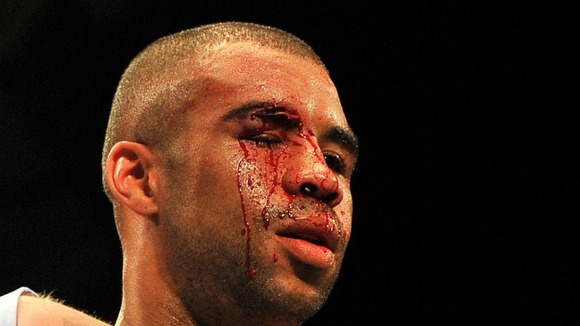 Rendall Munroe with a cut above his eye after the accidental head clash