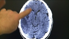 brain scan