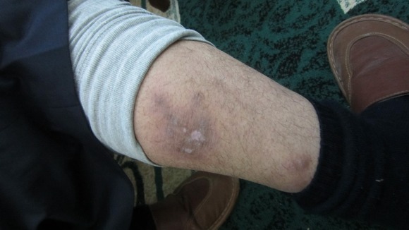 Syrian torture victim shows wounds