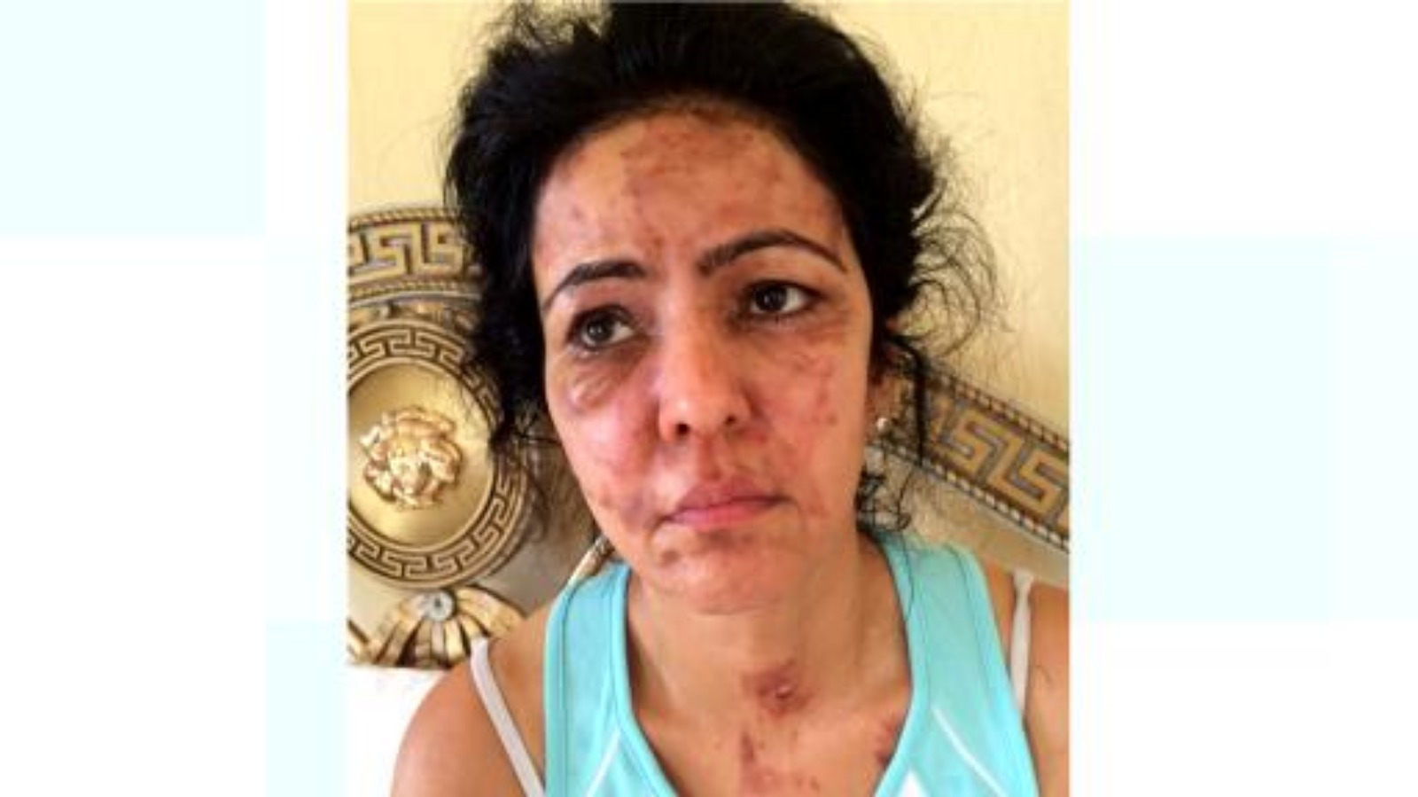 Secret Millionaire star warns of dangers after pressure cooker explodes