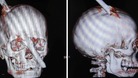 Eduardo Leite survived after being pierced through his skull by a 2-metre rod