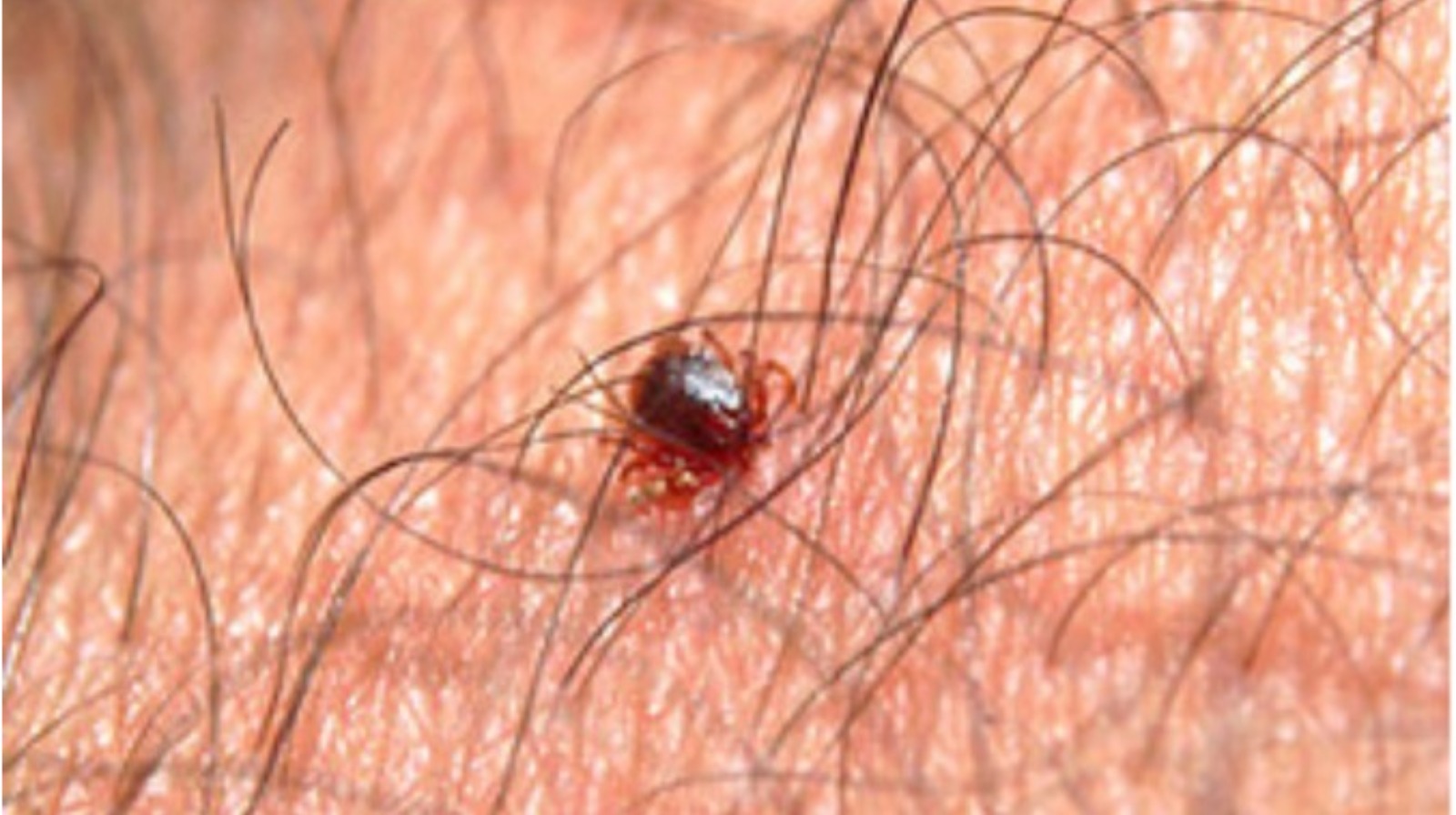 Lyme Disease | BadSpiderBites.com