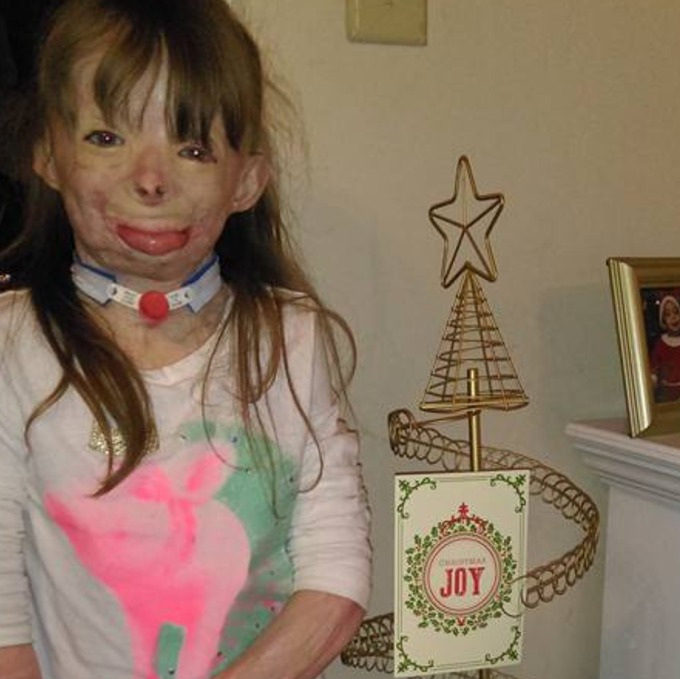 us girl with severe burns has one wish this christmas to receive