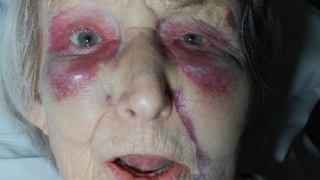 Pensioner's injuries.