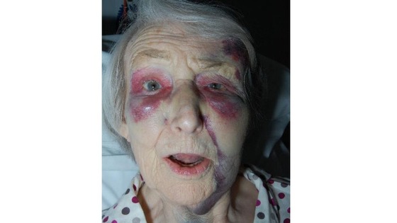 The victim of the attack, with severe bruising to her face.