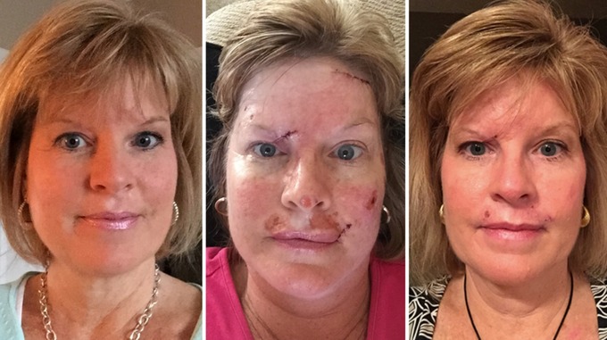 Judy Cloud's most recent surgery was to remove 23 skin cancer spots from her face