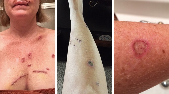 The 49-year-old has had four surgeries for skin cancer